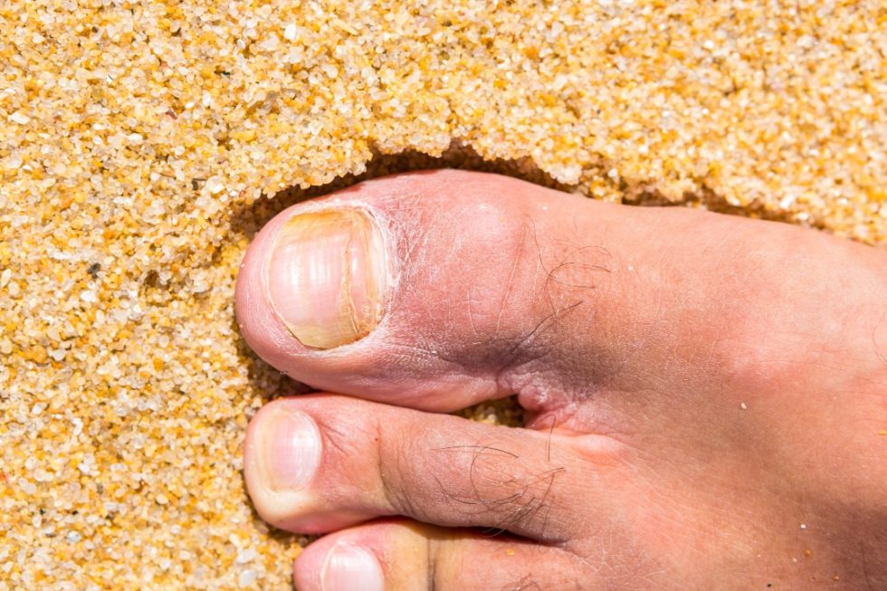 Topical And Laser Combination Therapy For Fungal Toenails Sierra Foot