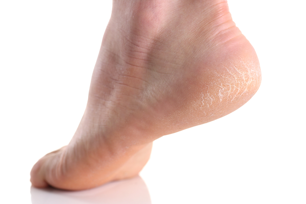 foot fissures