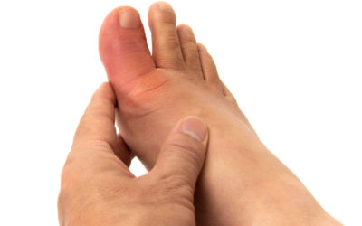 How to Manage Gout During the Holiday Season