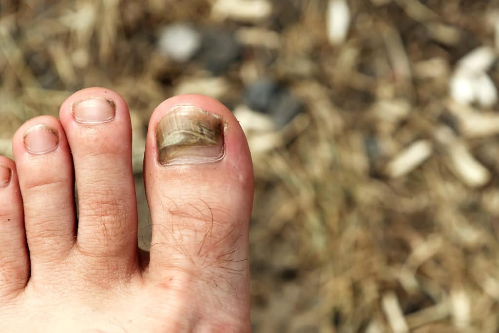 नेल फंगस (नाखून की बीमारी) के कारण, लक्षण और घरेलू इलाज - Nail Fungus  Symptoms and Home Remedies in Hindi