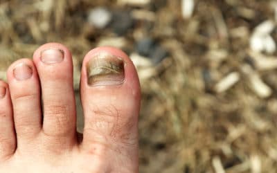 Do I Have a Bruised Toenail or an Infection?