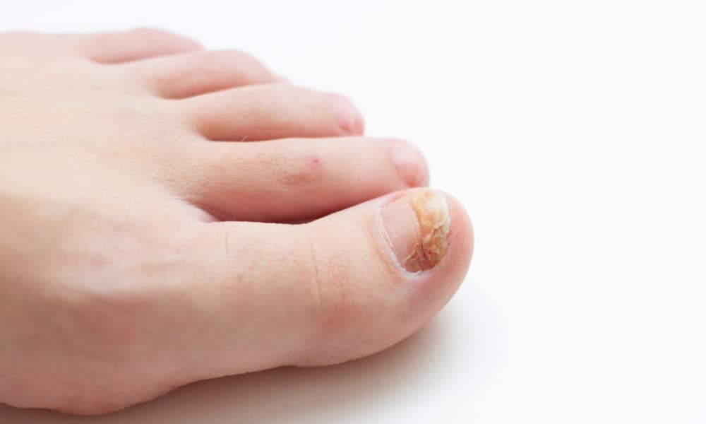 White background foot with toenail fungus on big toe
