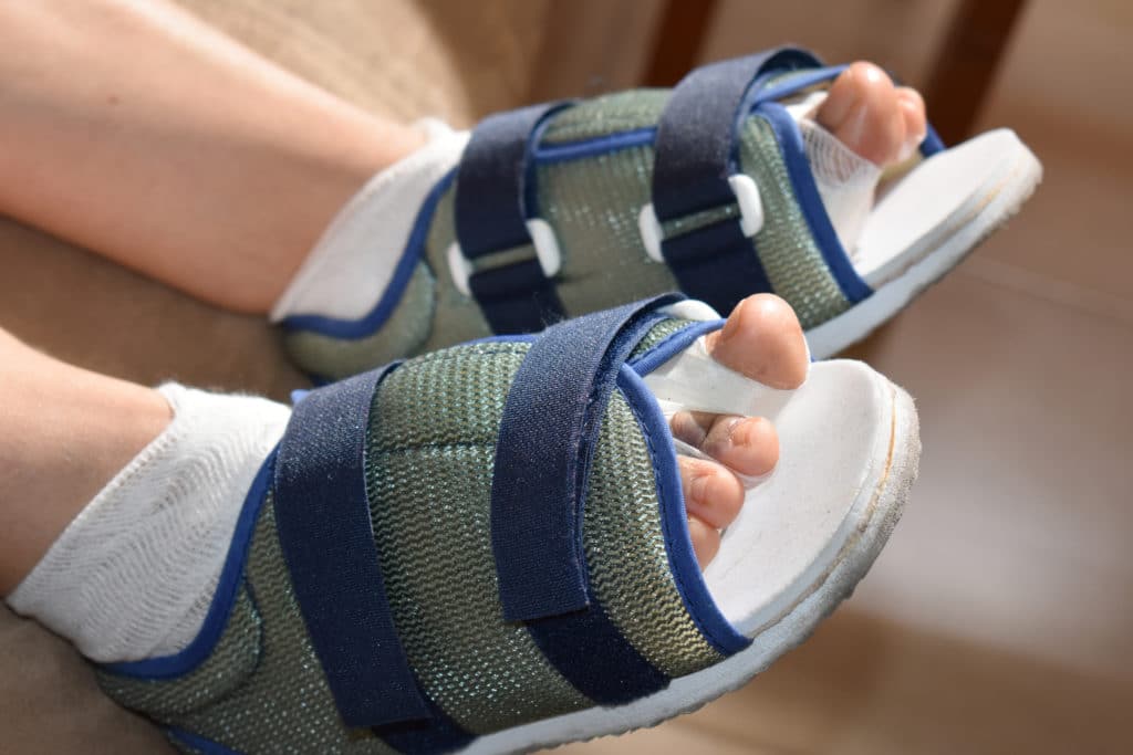 Lapiplasty Bunion Surgery Sierra Foot & Ankle