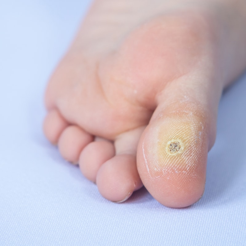 Closeup of foot with an infected wart placed on toe. Foot wart.