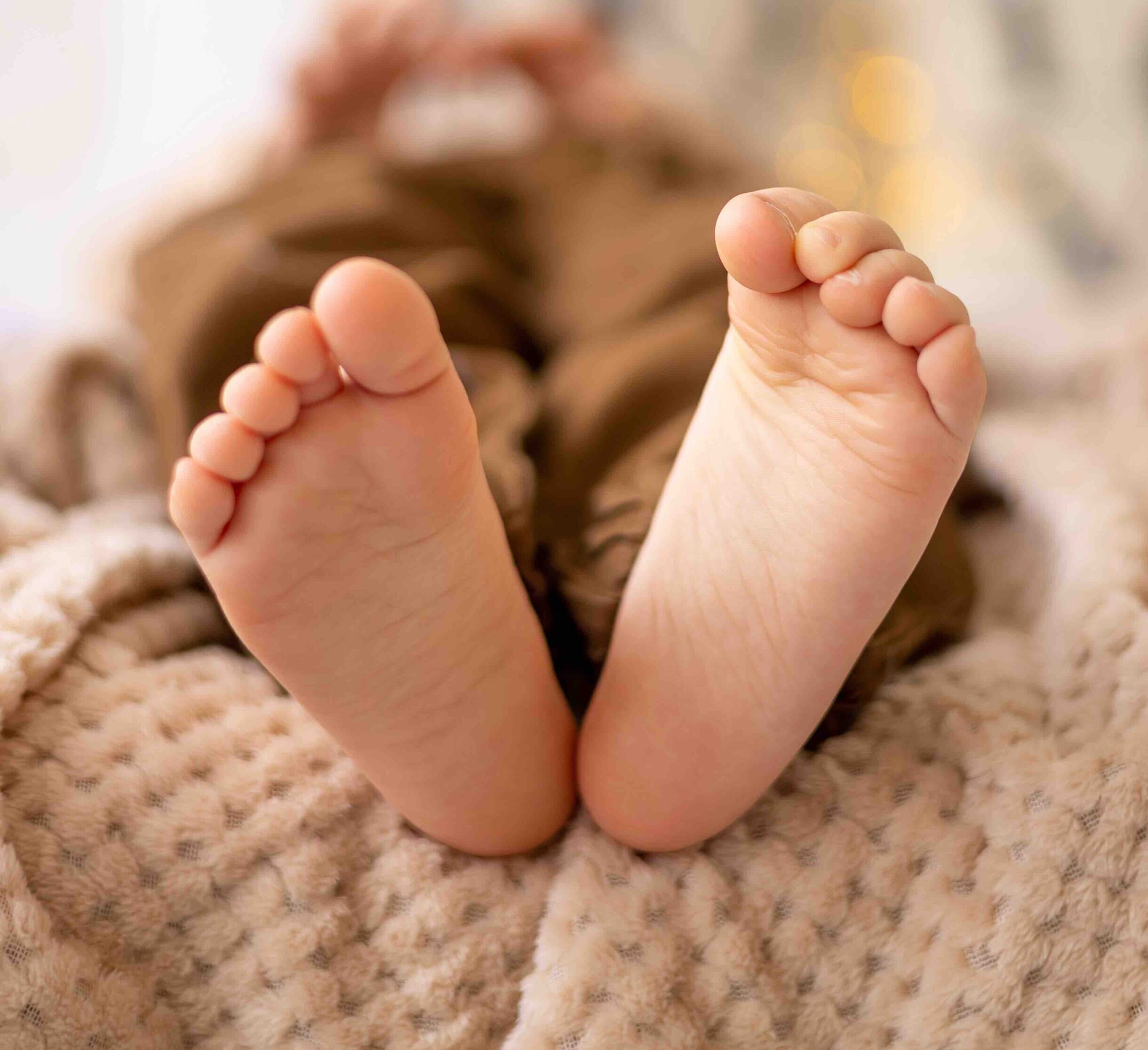 Child's feet with heel pain caused by Sever's Disease