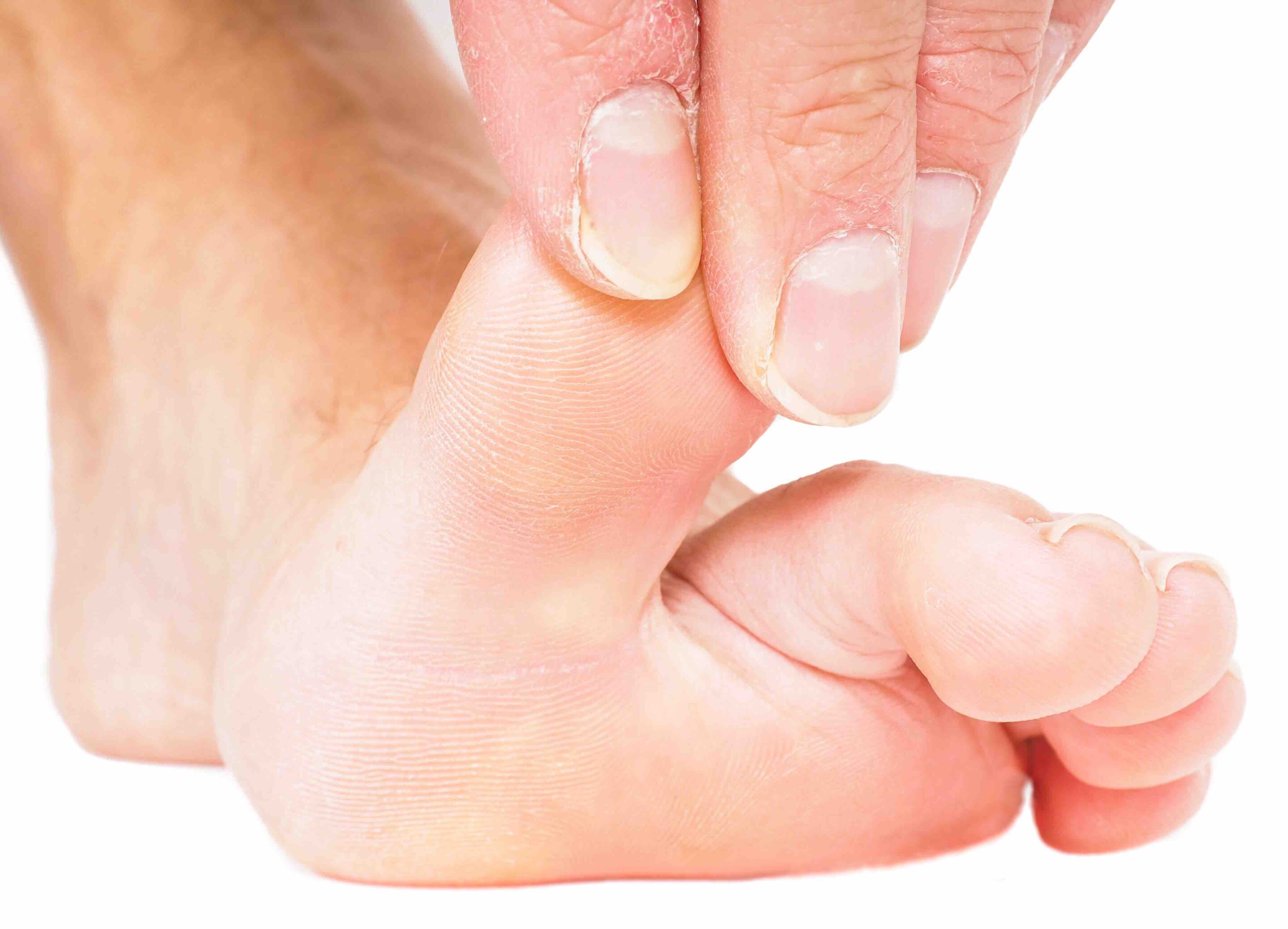 Holding up toe because of big toe pain